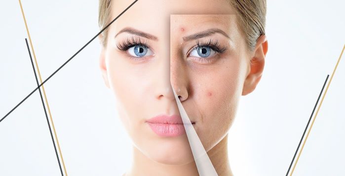 botox